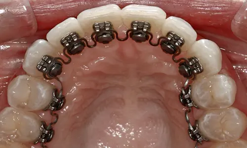 InBrace braces placed behind the teeth, seen from above