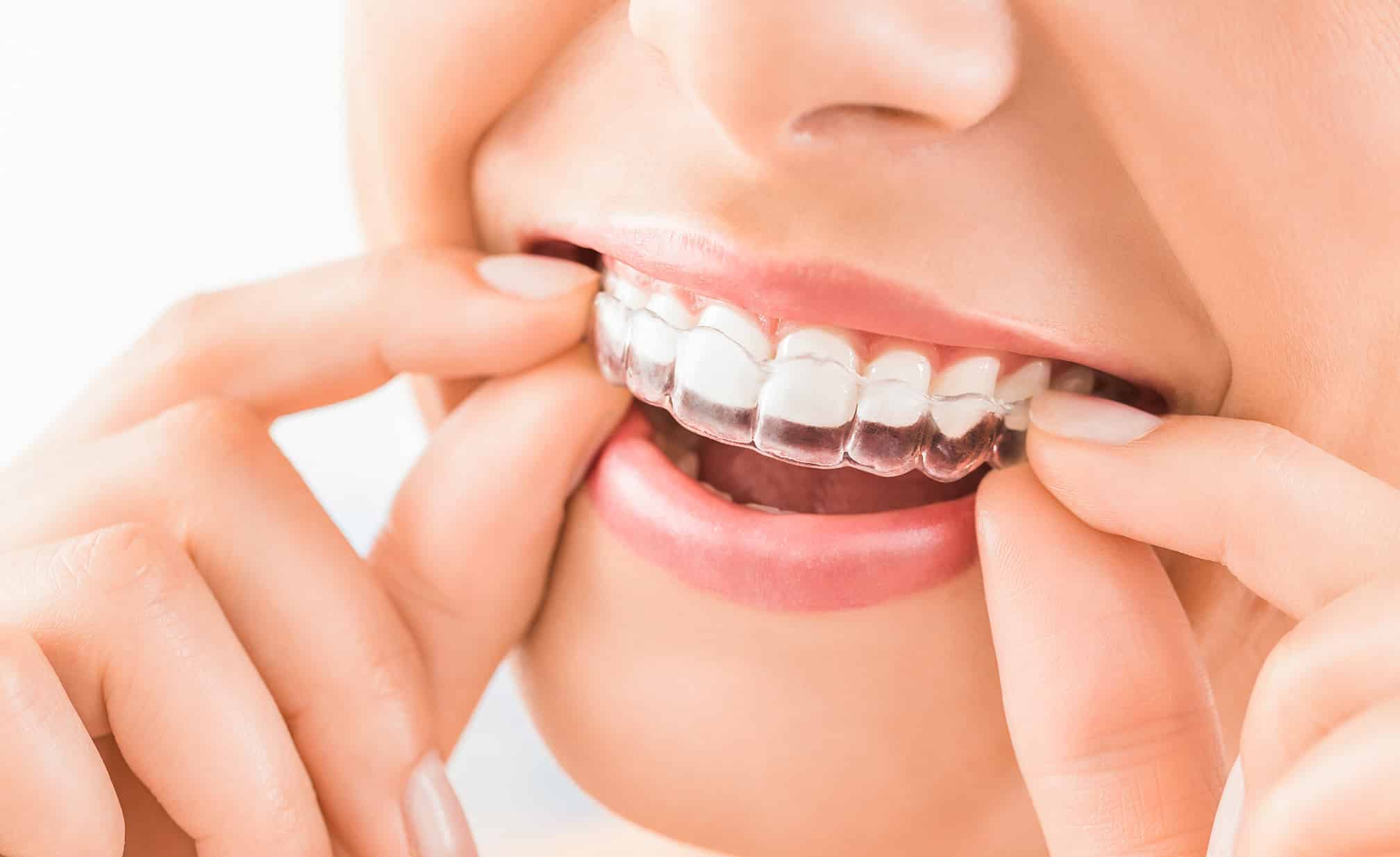 Invisalign treatment in Midland, TX