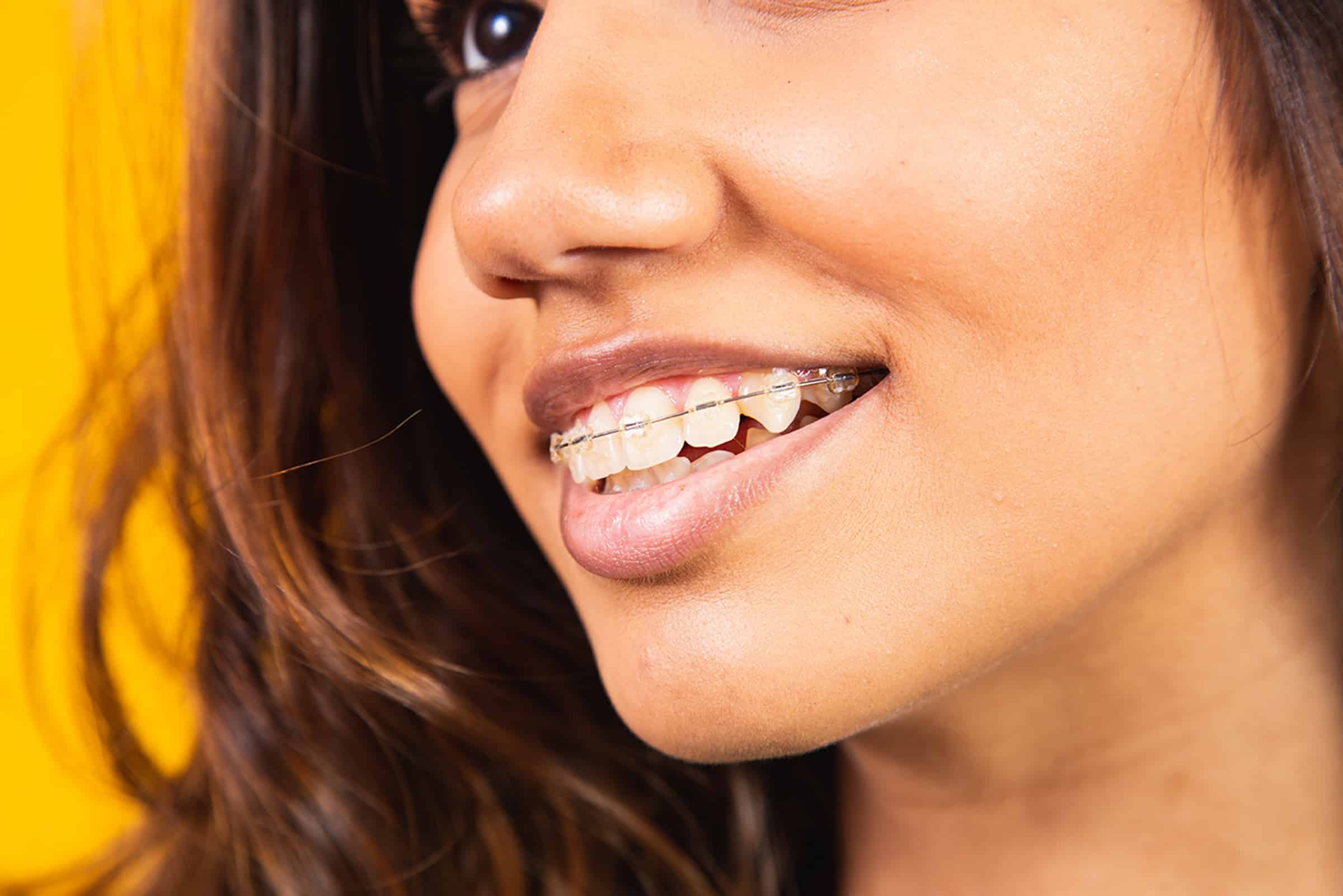 Woman smiling with ceramic braces orthodontic treatment in Midland, TX