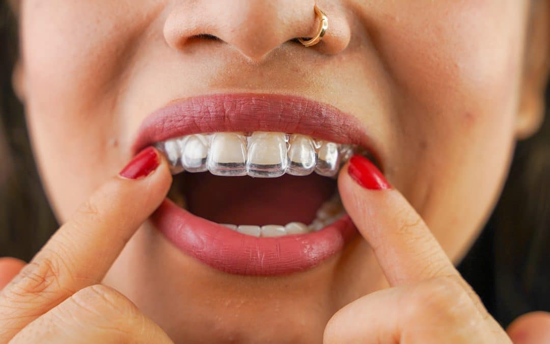 What Dental Problems Can Invisalign Fix?