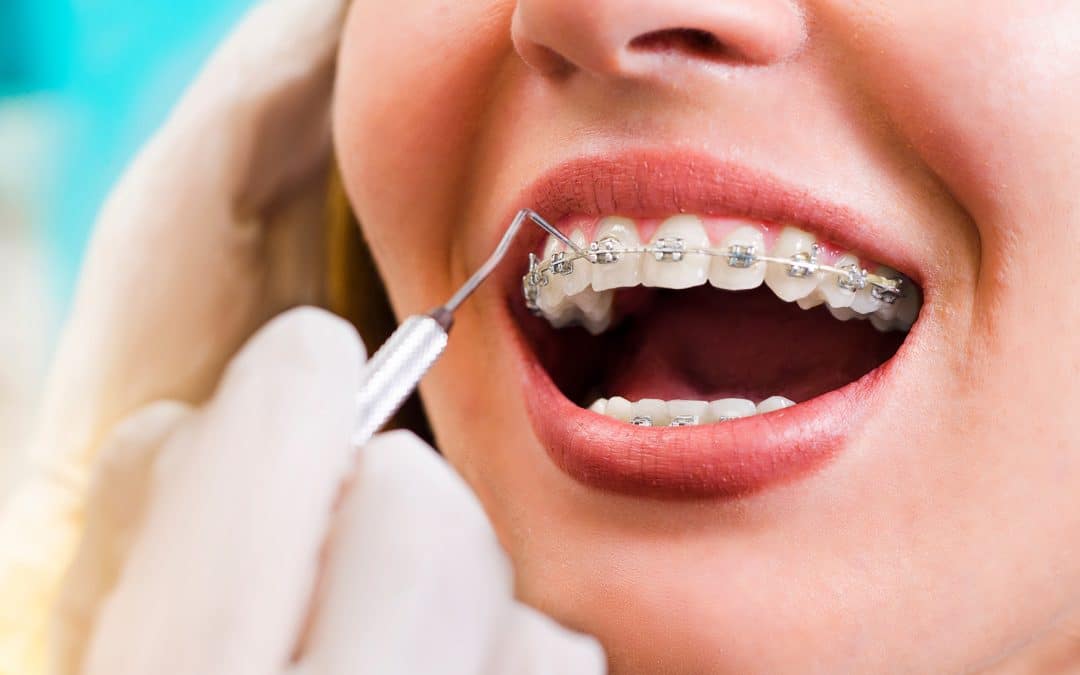 How Long Does Orthodontic Treatment Take?